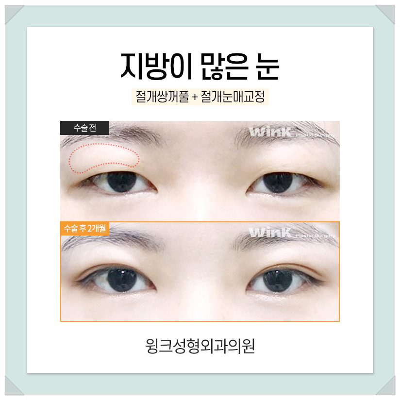 지방이많은눈 눈두덩이지방제거 절개쌍수비용을 알아보겠습니다. 관련 이미지 3