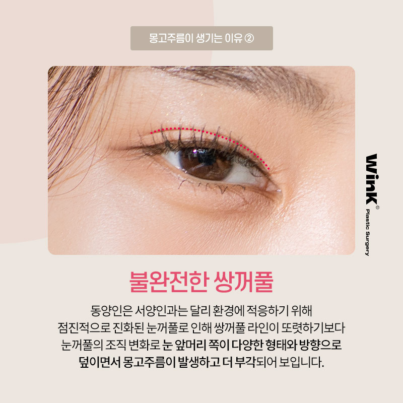 The Impact of Epicanthal Folds on Double Eyelid Surgery! Epicanthoplasty, Epicanthoplasty Cost, Sinsa Epicanthoplasty image 4
