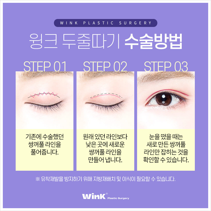 쌍꺼풀재수술 두줄따기눈재수술 윙크성형외과 소세지눈재수술 관련 이미지 4