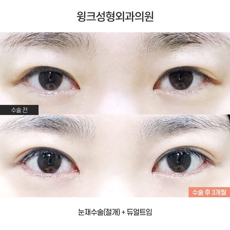 듀얼트임으로 자연스럽게 눈을 키우는 방법에 대해 알아볼까요? 관련 이미지 1