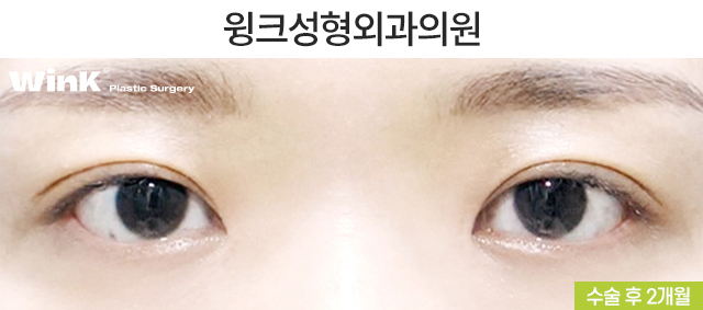 How Should Double Eyelid Surgery Be Performed for Small, Narrow Eyes? image 6
