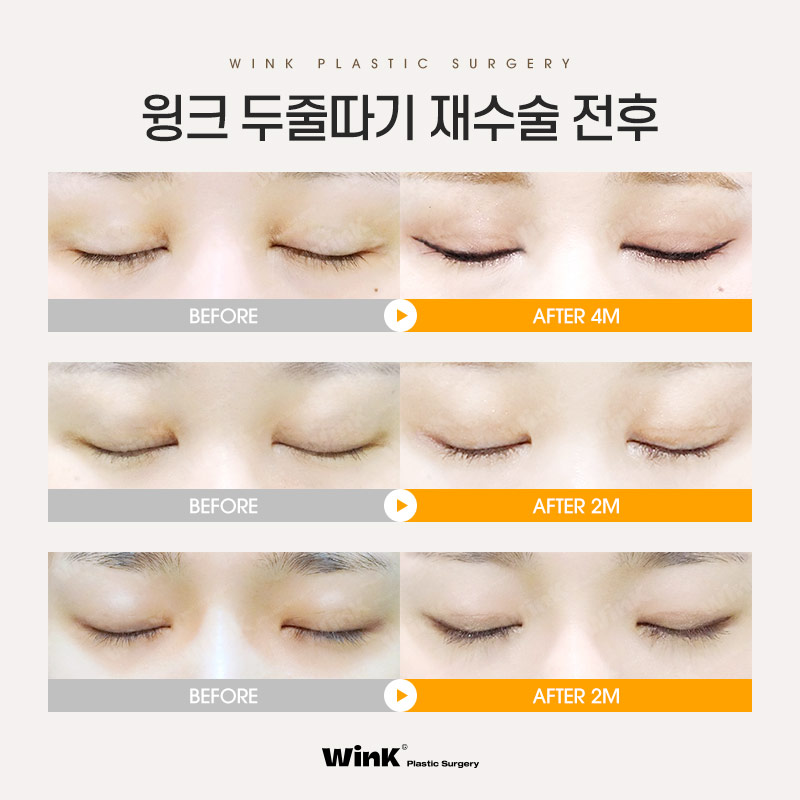 Does double-eyelid surgery with an incision always leave a scar? Revision eyelid surgery scars explained by Wink Plastic Surgery Clinic! image 7