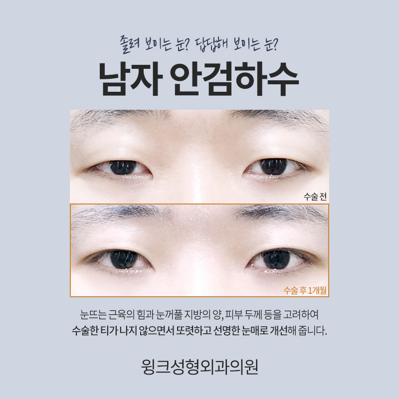 남자안검하수 또렷하게 교정하여 시원한 인상으로 개선하는 방법 관련 이미지 2
