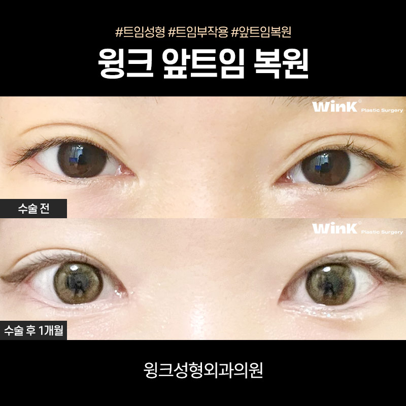 앞트임 복원 한달차 후기 관련 이미지 5