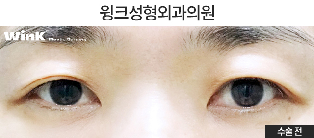 About Upper Eyelid Surgery for Middle-Aged Patients image 2