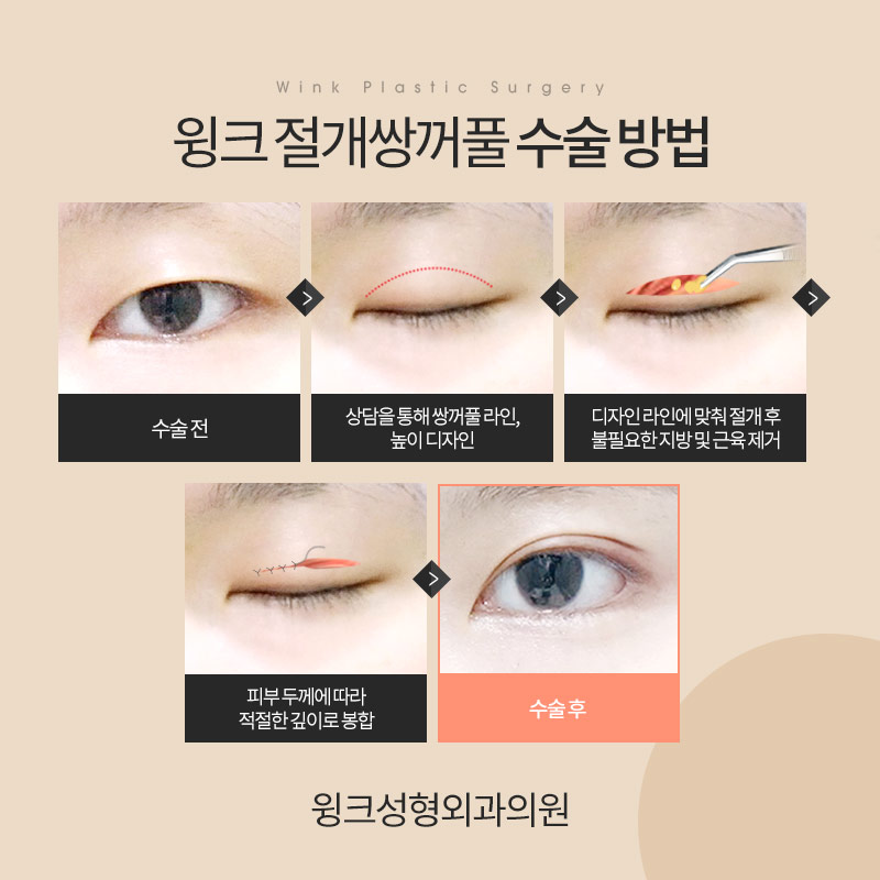 Let’s Learn About Incisional Double Eyelid Surgery image 5