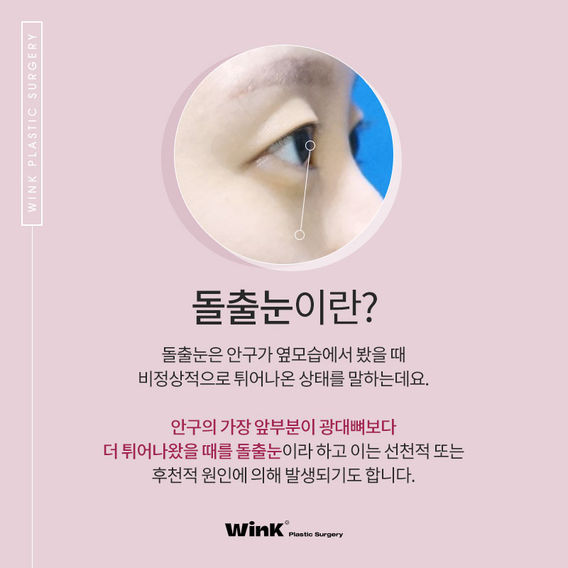내 눈은 안구가 앞으로 튀어나온 돌출눈? 윙크성형외과에서 알려드리는 돌출눈성형 진단법! 관련 이미지 2