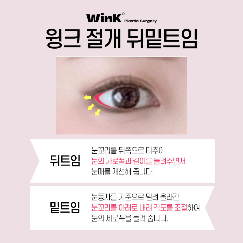 Elegant and Bright Eyes with Incisional Outer and Lower Canthoplasty at Wink Plastic Surgery! image 3