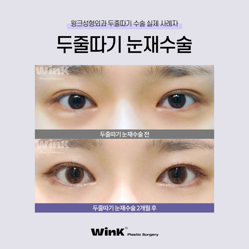 두껍고 높은 소세지눈? 윙크성형외과 두줄따기로 라인낮추기! 관련 이미지 7