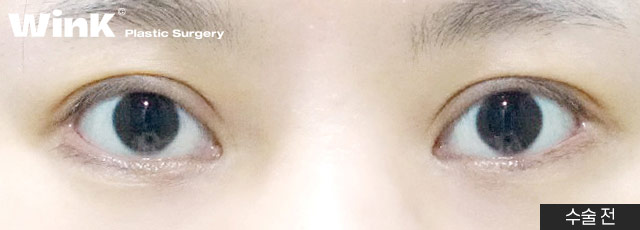 Are All Revision Eyelid Surgeries the Same? For High Crease "Sausage Eyes," Use Two-Line Technique to Lower the Front Line image 4
