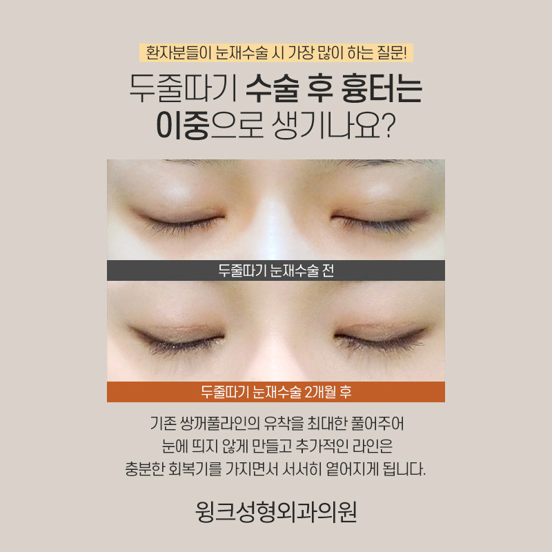 두줄따기로 라인 낮추기 하고 나서 흉터는 어떨까? 관련 이미지 6
