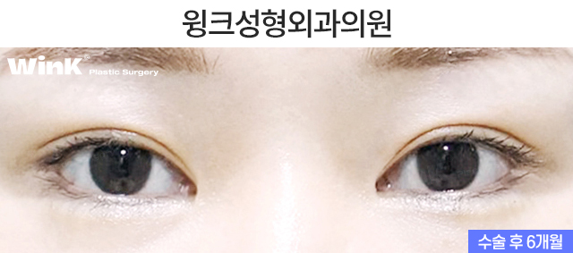 Let’s Learn About Double-Eyelid Revision Surgery with an Incision for a Thick Front Line image 7
