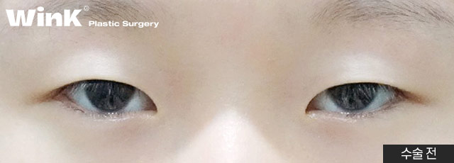 Non-incisional Eye Correction Review: A Natural, Clear Eye Shape! image 8