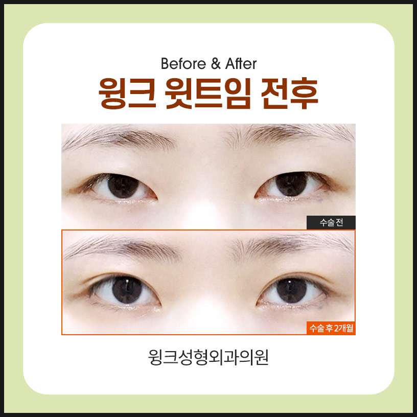 트임성형 윗트임으로 전체적으로 눈을 시원하게! 관련 이미지 3