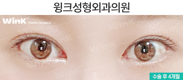 뒷밑트임으로 눈의 숨겨진 공간을 찾자! 윙크 듀얼트임 관련 이미지 6