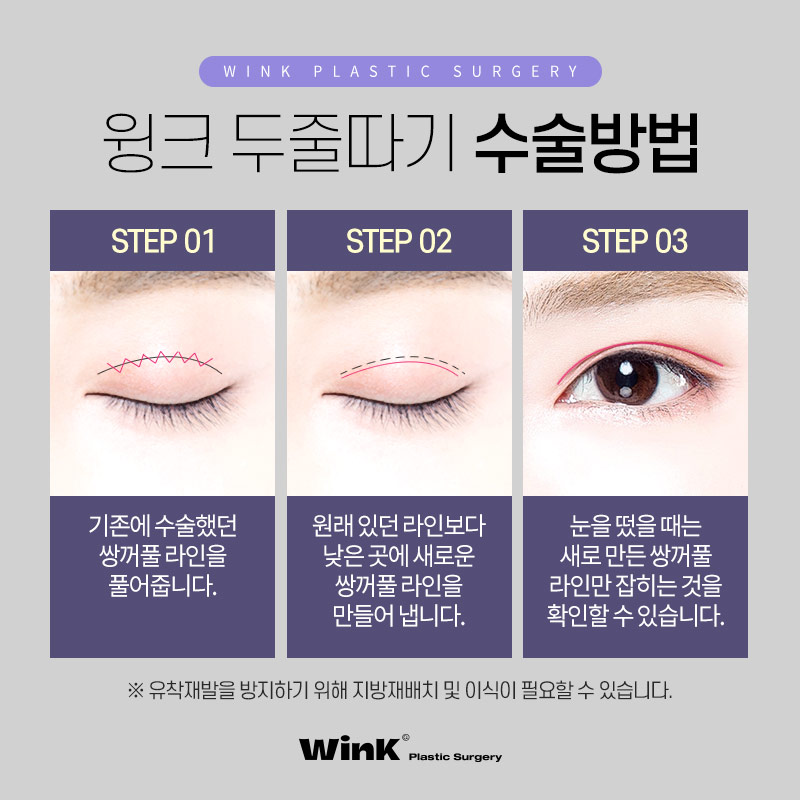 두껍고 높은 소세지눈? 윙크성형외과 두줄따기로 라인낮추기! 관련 이미지 4