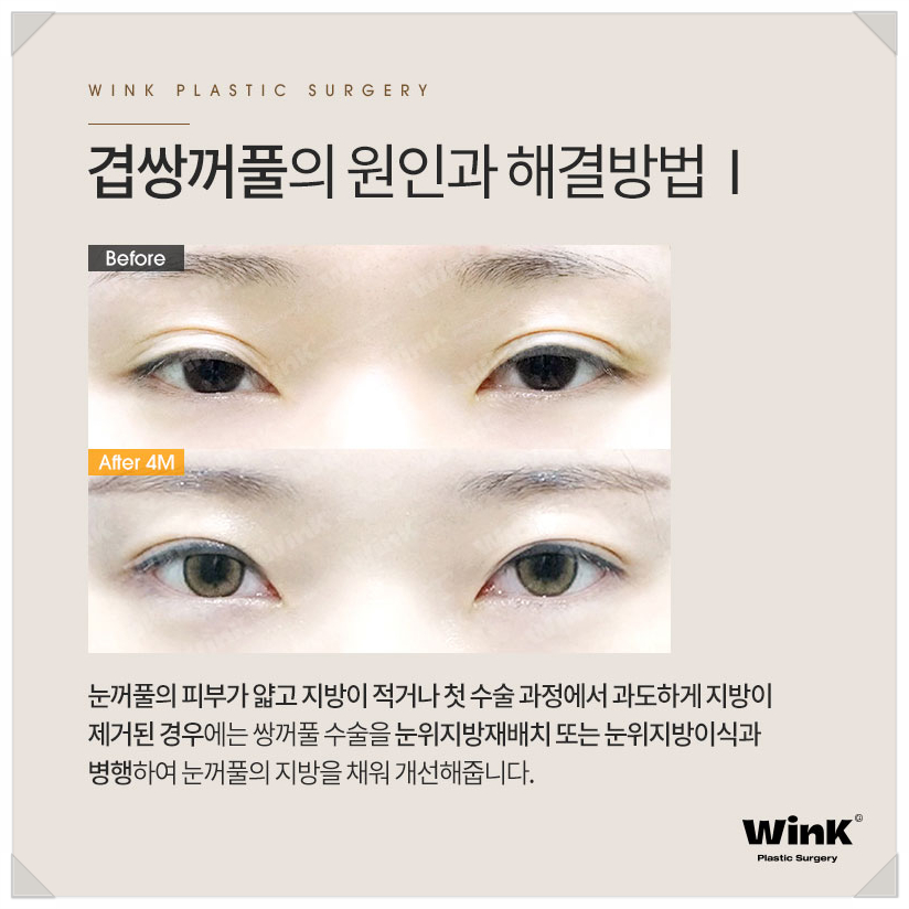 겹주름쌍꺼풀 쌍커풀여러겹 윙크성형외과  겹쌍 쌍커풀주름 관련 이미지 4