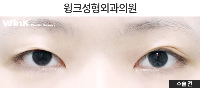 통통한 쌍꺼풀과 겹주름, 해결 방법은? 관련 이미지 2