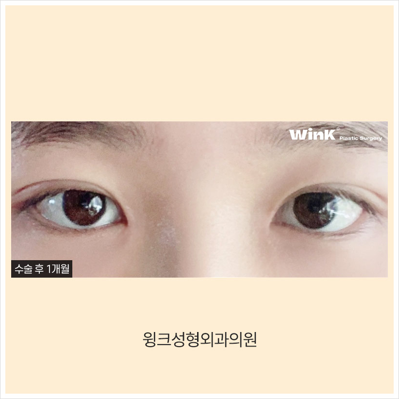 인라인쌍꺼풀 윙크성형외과 자연유착쌍꺼풀후기 자연유착법 관련 이미지 5