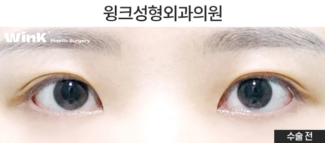 Shall We Learn About Revision Double Eyelid Surgery? image 5