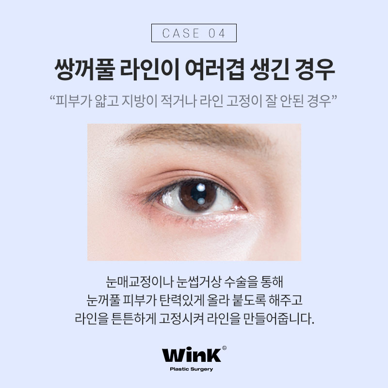 Types of Double Eyelid Revision Surgery and Solutions at Wink Plastic Surgery, Sinsa Station image 6