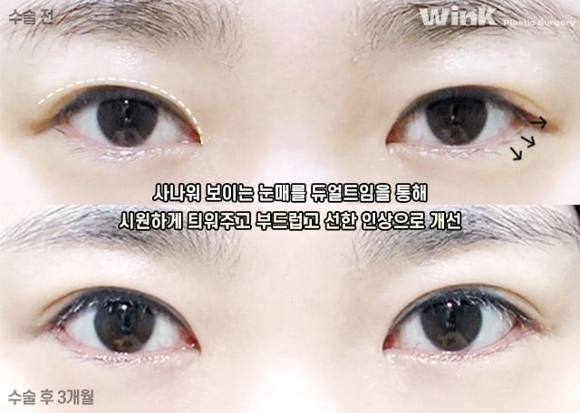 듀얼트임으로 자연스럽게 눈을 키우는 방법에 대해 알아볼까요? 관련 이미지 4
