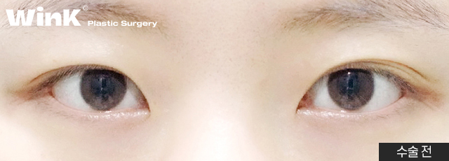 Fast Return to Daily Life and Natural Lines with Wink Natural Adhesion! image 3