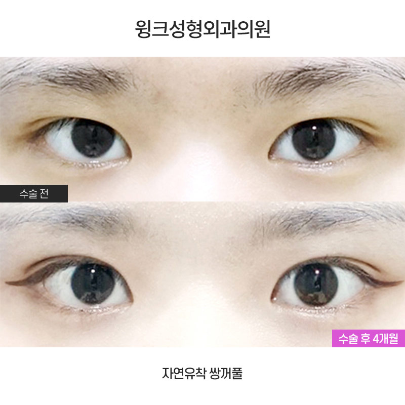 Let’s Learn About Before and After Natural Adhesion Double Eyelid Surgery image 1
