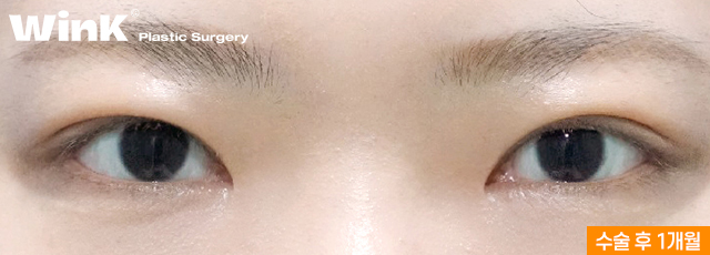 두줄따기 쌍꺼풀 라인낮추기로 부담스러운 눈매는 그만! 관련 이미지 9