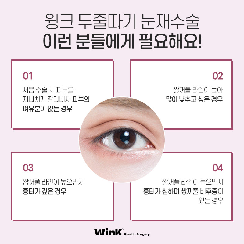두줄따기 눈재수술로 수술 직후에도 자연스럽게! 관련 이미지 5