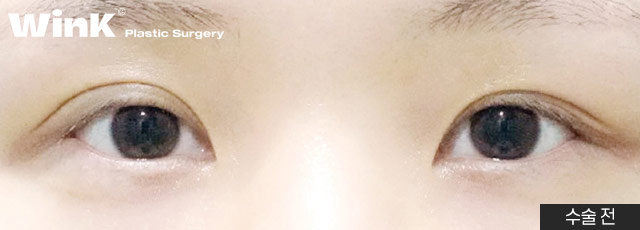 Wink’s Upper Blepharoplasty Revision Surgery, Considering Both Function and Aesthetics image 7
