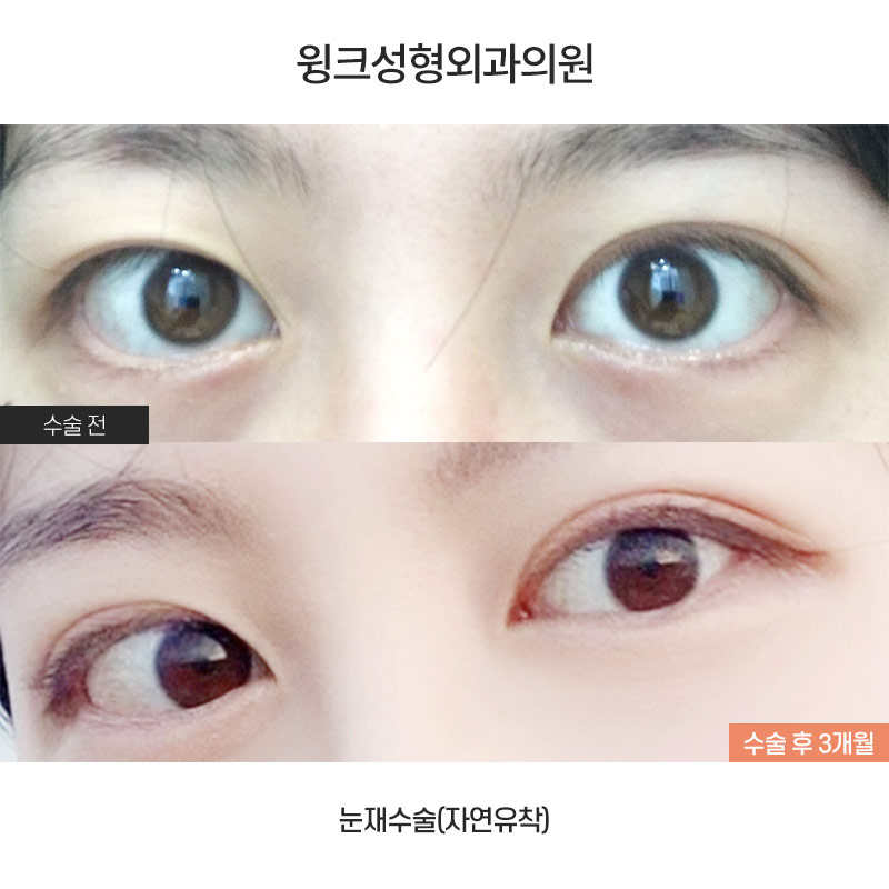 자연유착 재수술 시 주의점에 대해 알아보겠습니다. 관련 이미지 1