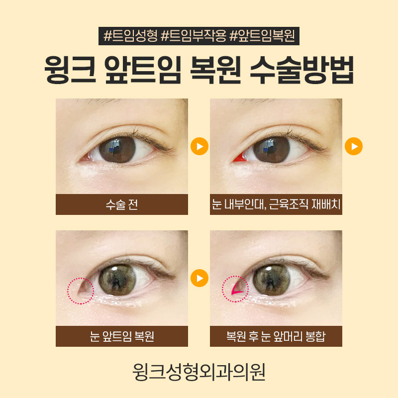앞트임 복원 한달차 후기 관련 이미지 6