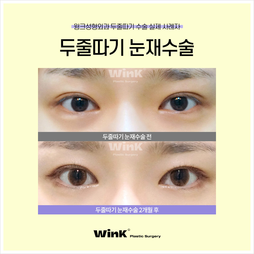 쌍꺼풀재수술 두줄따기눈재수술 윙크성형외과 소세지눈재수술 관련 이미지 7