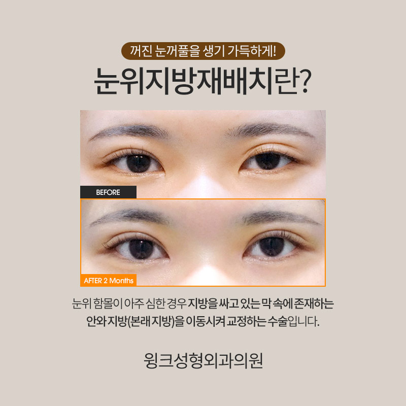 눈위지방재배치 눈지방재배치 꺼진 눈꺼풀을 생기 가득하게! 관련 이미지 2