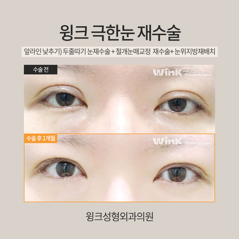 Let’s Learn About Revision Surgery for Severe Eyes? image 5