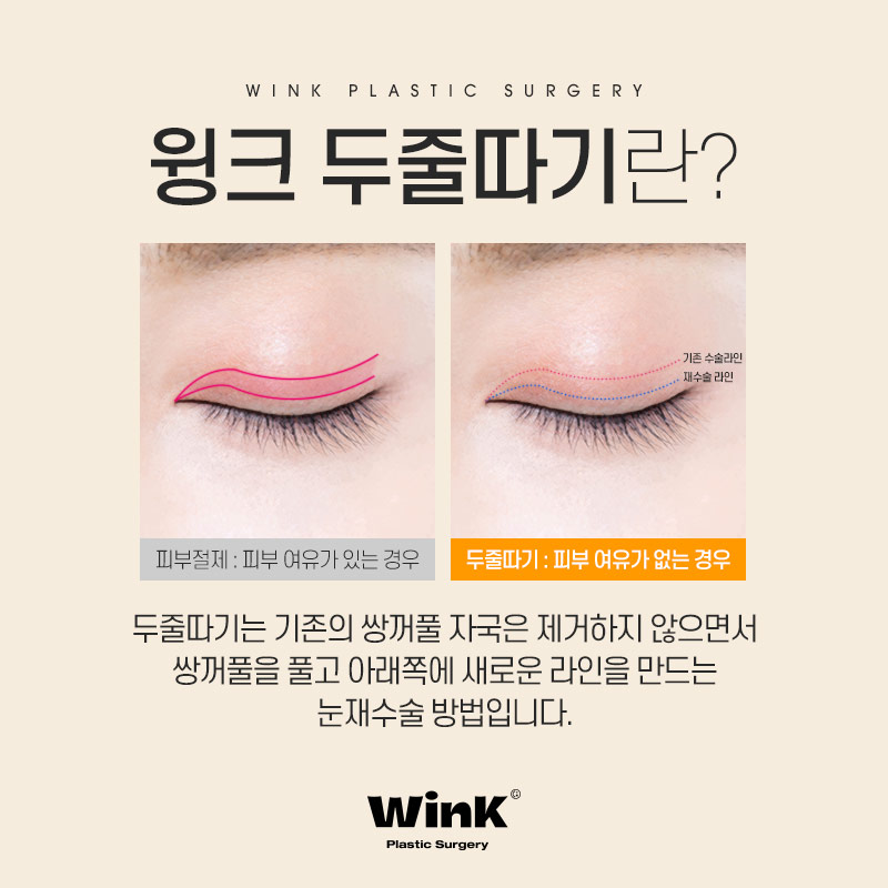 절제 없이 눈재수술 하고 싶다면? 윙크성형외과 두줄따기 눈재수술 관련 이미지 2