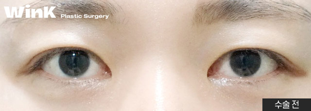 Wink Plastic Surgery Double Eyelid Revision Surgery, Pursuing Natural Results by Identifying the Exact Cause of Failure image 6