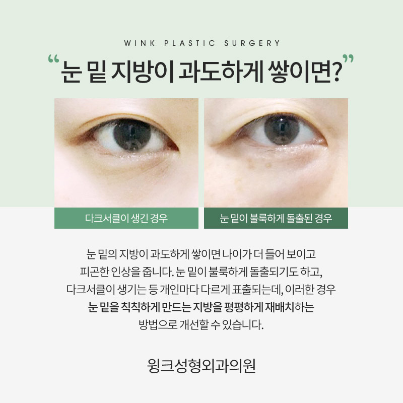 다크서클이 고민이라면, 윙크성형외과 눈밑지방재배치로 깔끔하게! 관련 이미지 2