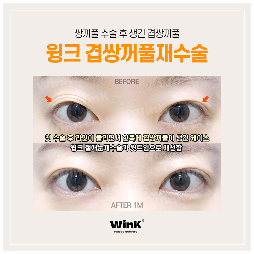 Multiple Eyelids, Double Eyelid Creases, Double Folded Eyelids, Eyelid Creases, Wink Plastic Surgery, Double Eyelids, Double Eyelid Revision Cost image 7