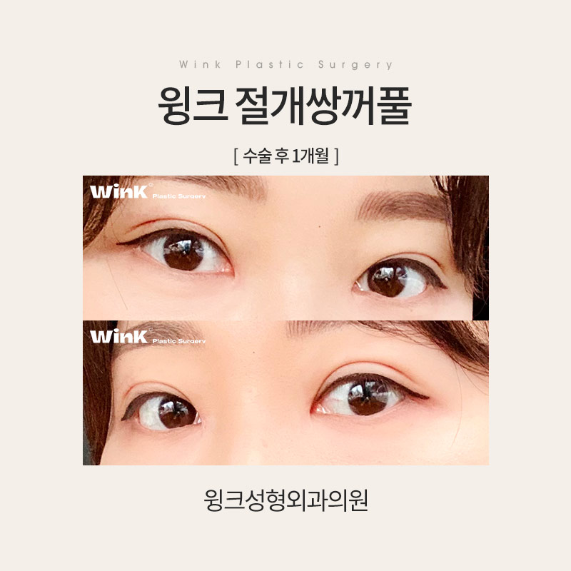 Let’s Learn About Incisional Double Eyelid Surgery image 7