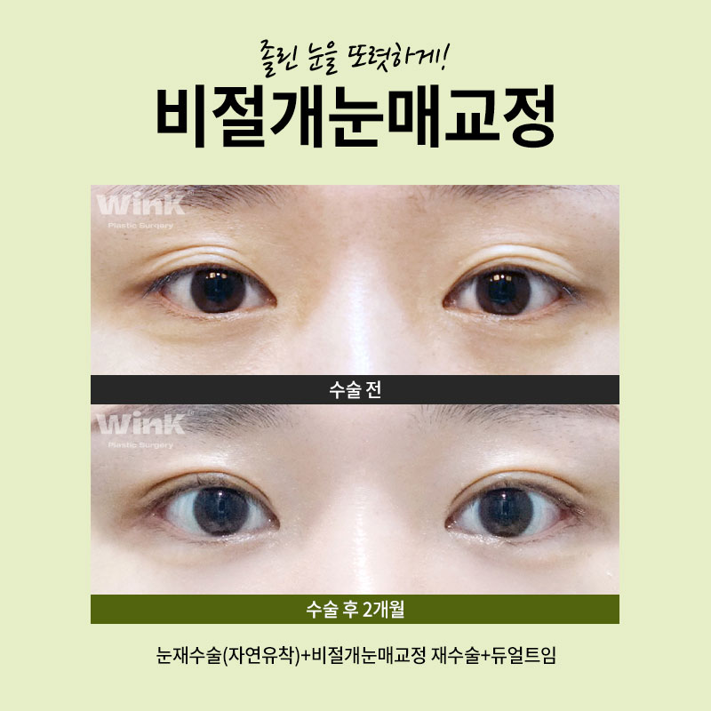 Improvement for Sleepy Eyes? Get Clear, Refreshing Eyes with Non-Incisional Eye Correction at Wink Plastic Surgery! image 6