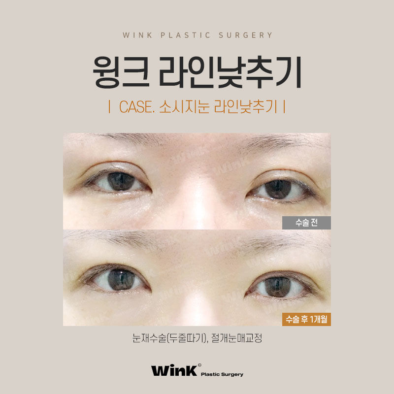 윙크성형외과 라인낮추기로 흉터 없이 원하는 쌍꺼풀 높이로! 관련 이미지 6