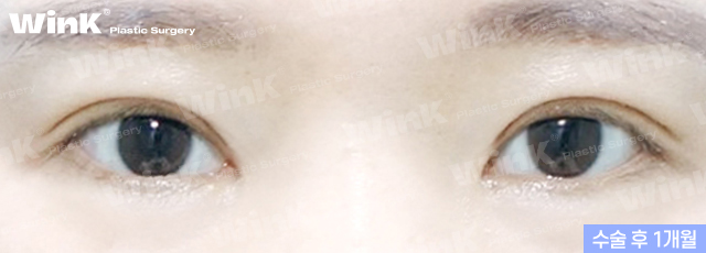 Lowering the Double Eyelid Line: Making Thick Double Eyelids (Sausage Eyes) Look Natural with a Two-Line Revision Surgery! image 7