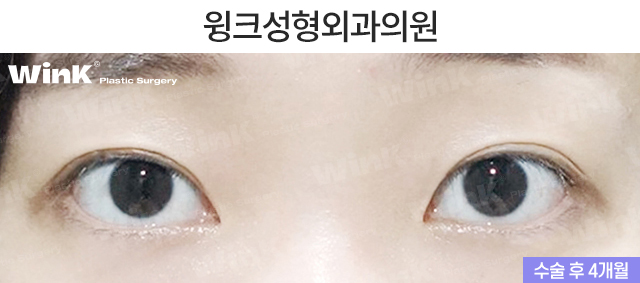절개 눈매교정 쌍꺼풀 수술에 대해 알아볼까요? 관련 이미지 3