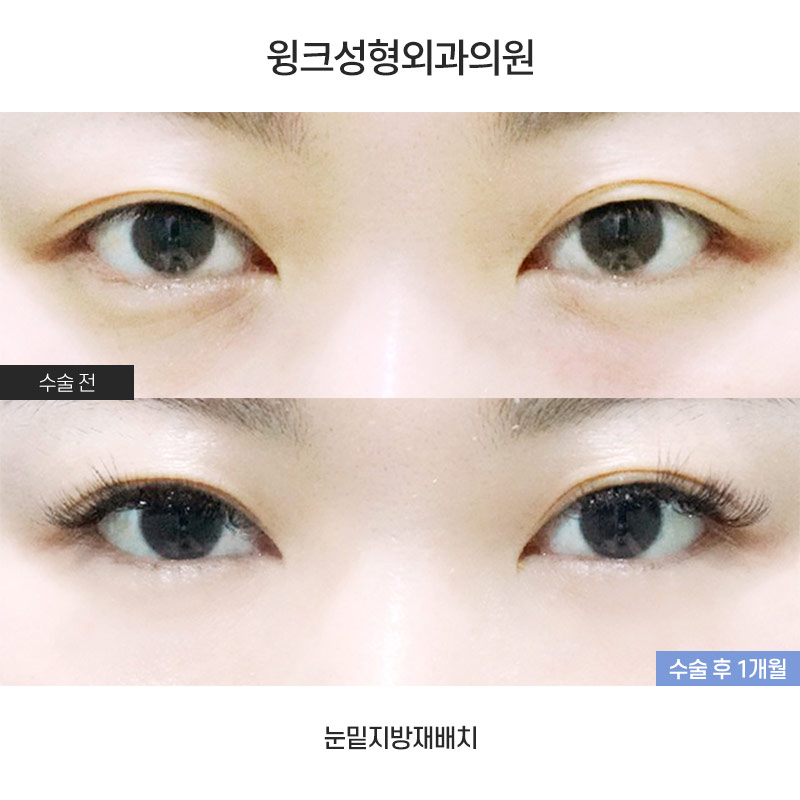 Lower Eyelid Fat Repositioning: Who Is It Effective For? image 1