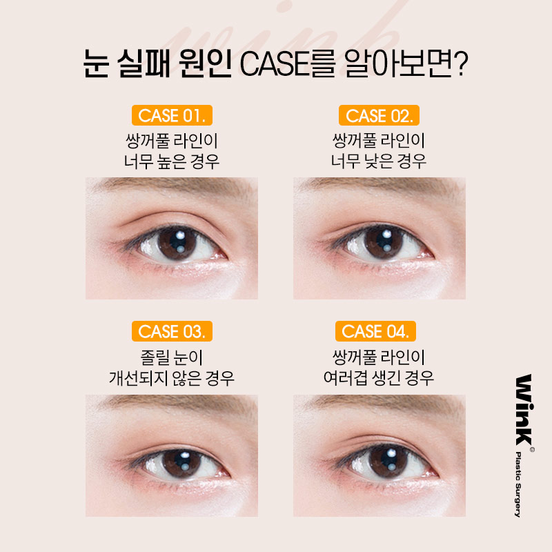 윙크성형외과에서 알려드리는  다양한 실패원인! 눈재수술후기 신사눈재수술잘하는곳 관련 이미지 2
