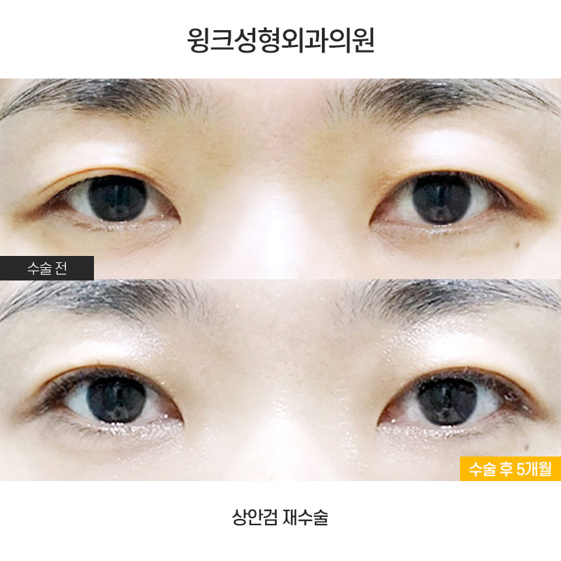 About Upper Eyelid Surgery for Middle-Aged Patients image 1