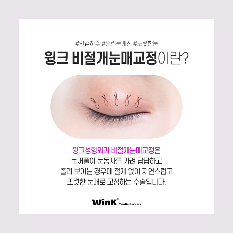 눈동자 노출량을 키워주어 또렷한 눈매로 만들어주는 윙크성형외과 눈매교정! 관련 이미지 6