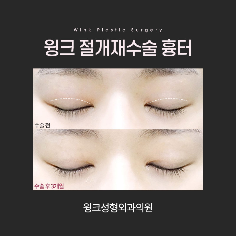 절개 쌍꺼풀 흉터에 대해 알아보겠습니다. 관련 이미지 3
